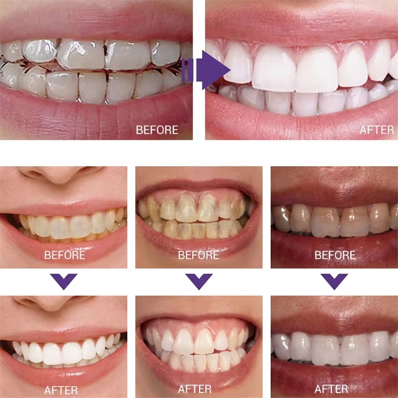 Отбеливающая зубная паста-гель – обзор и цена Teeth Whitening Korea