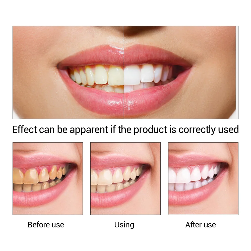 FTEENPLY отбеливание зубов быс – обзор и цена Teeth Whitening Vape